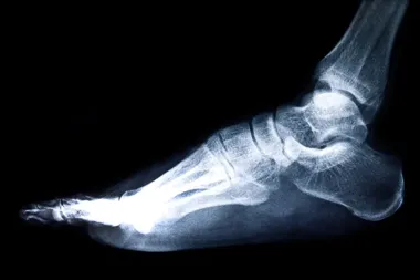 Jak budowa anatomiczna stopy wpływa na ryzyko urazów i kiedy konieczna jest interwencja ortopedyczna?